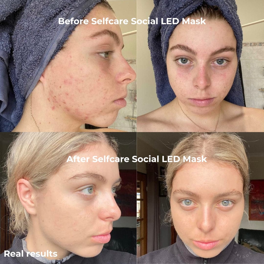 Social Skin 3-in-1 LED Light Therapy Face Mask